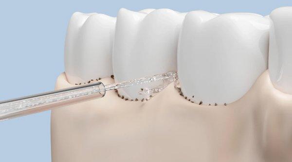 Xiaomi Water Flosser Replacement Tips